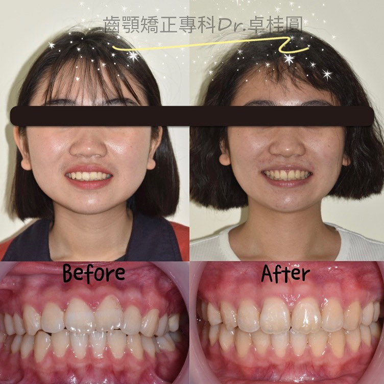 牙齒矯正前後對比